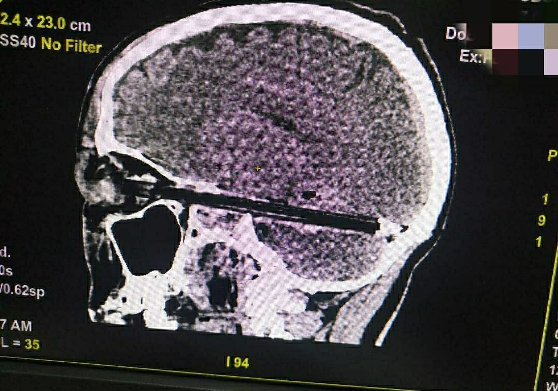 Các bác sĩ Nga cứu một người đàn ông bị bút bi cắm vào sọ não - Sputnik Việt Nam, 1920, 09.02.2021