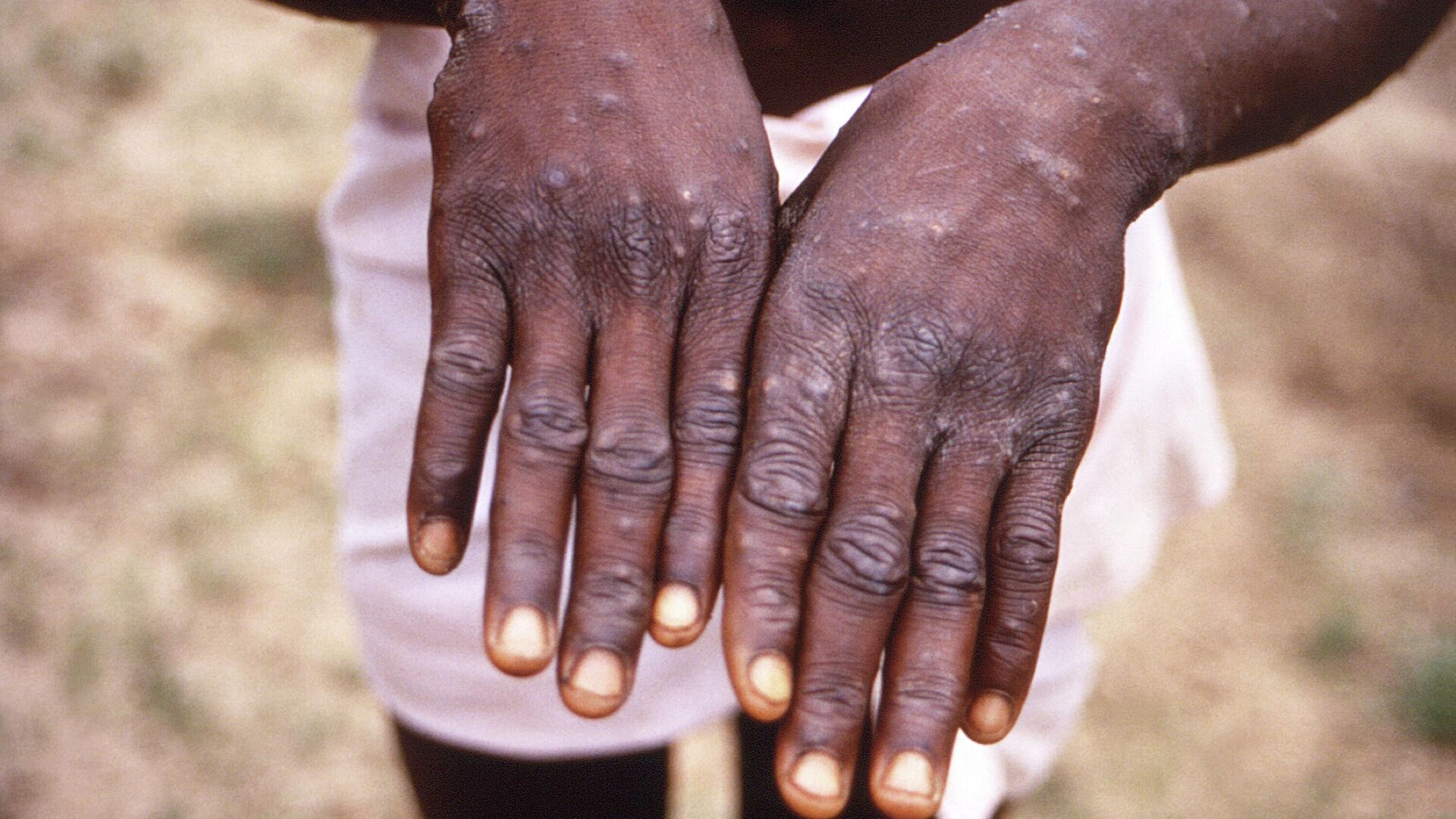 На этом снимке 1997 года изображены тыльные поверхности рук пациента с обезьяньей оспой, у которого были обнаружены появление характерной сыпи в период выздоровления - Sputnik Việt Nam, 1920, 24.05.2022