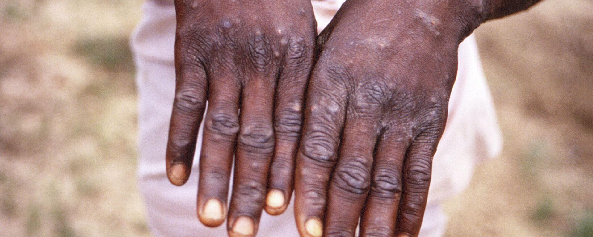 На этом снимке 1997 года изображены тыльные поверхности рук пациента с обезьяньей оспой, у которого были обнаружены появление характерной сыпи в период выздоровления - Sputnik Việt Nam, 1920, 24.05.2022