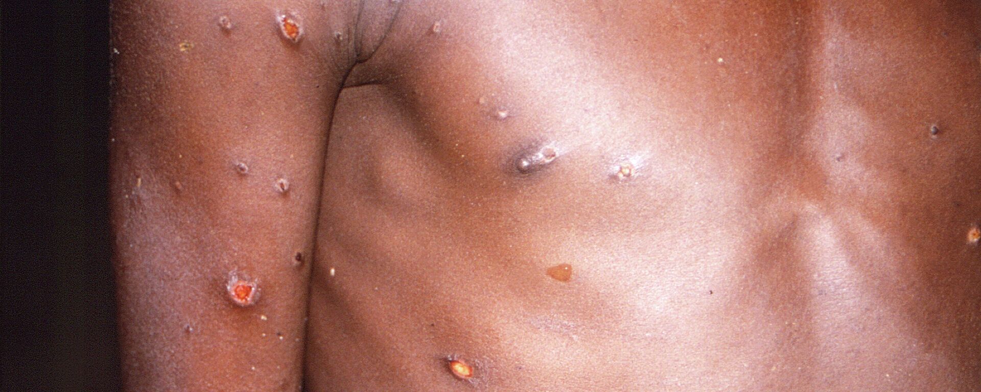 Ảnh chụp năm 1997 cho thấy cánh tay phải và trên người bệnh nhân có hàng loạt vết thương trên da do bệnh đậu khỉ  - Sputnik Việt Nam, 1920, 01.08.2022