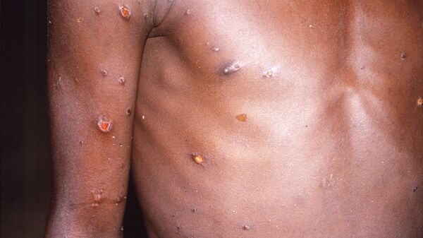 Ảnh chụp năm 1997 cho thấy cánh tay phải và trên người bệnh nhân có hàng loạt vết thương trên da do bệnh đậu khỉ  - Sputnik Việt Nam