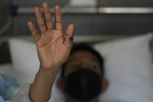 Bệnh nhân thủy đậu trong bệnh viện ở Lima. - Sputnik Việt Nam