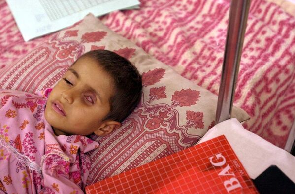 Alla Saleem, bốn tuổi, bị một khối u trong mắt do bom uranium nghèo trong Chiến tranh vùng Vịnh, tại Bệnh viện Nhi đồng Gazwan ở Basra, miền nam Iraq. - Sputnik Việt Nam