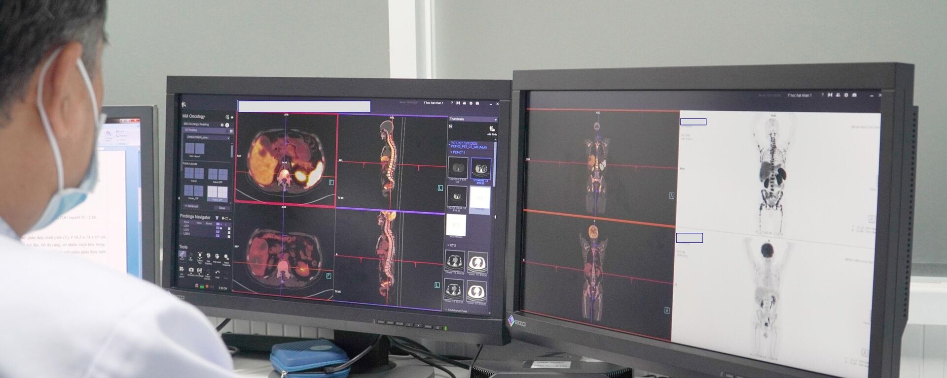 Hình ảnh chụp PET/CT của bệnh nhân tại Bệnh viện Chợ Rẫy Thành phố Hồ Chí Minh. - Sputnik Việt Nam, 1920, 07.12.2023