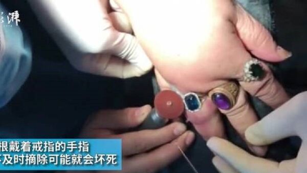 Lính cứu hỏa cắt 7 chiếc nhẫn thít chặt ngón tay có nguy cơ hoại tử của một cụ bà - Sputnik Việt Nam