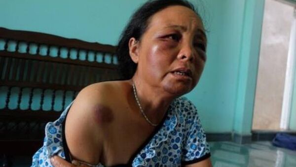 Bà Phúc (một trong 2 người phụ nữ bị đánh) mặt mũi vẫn sưng tím, đau nhức vì bị nhiều người dân hành hung - Sputnik Việt Nam
