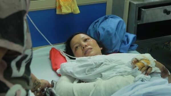 Thoát chết trong gang tấc nhưng di chứng sau vụ tai nạn kinh hoàng để lại trên thân thể chị Thơm và con trai sau này là không nhỏ. - Sputnik Việt Nam