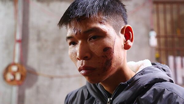 Anh Đặng Đình Tiến vẫn chưa lành vết thương sau vụ nổ sáng 3/1. - Sputnik Việt Nam