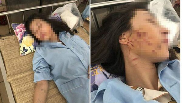 Hình ảnh chị L.T.G. bị thương ở vùng mặt đang được điều trị tại bệnh viện - Sputnik Việt Nam