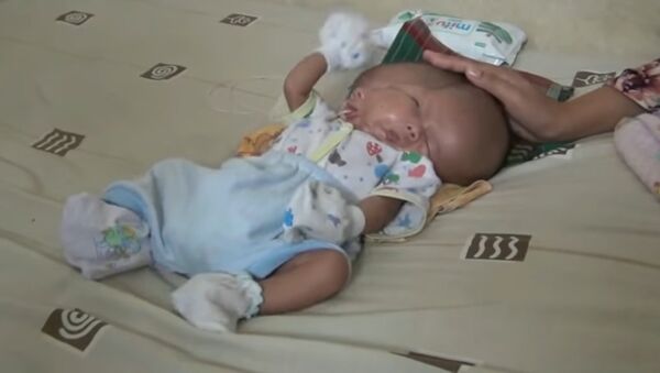 Một đứa trẻ hai khuôn mặt được sinh ra ở Indonesia - Sputnik Việt Nam
