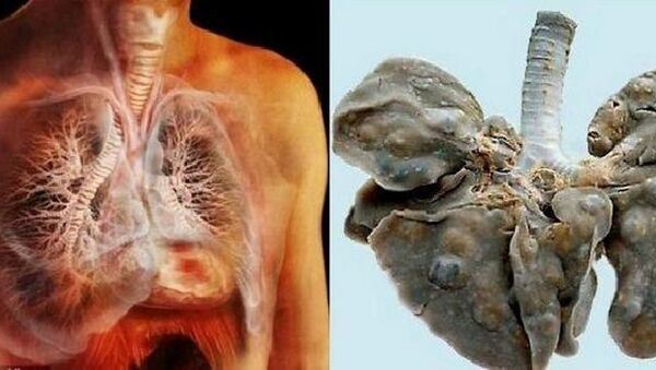 Lá phổi bị nhiễm sán - Sputnik Việt Nam