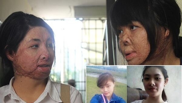 2 cô gái bị chồng đốt tựa vào nhau tìm lại hình hài - Sputnik Việt Nam