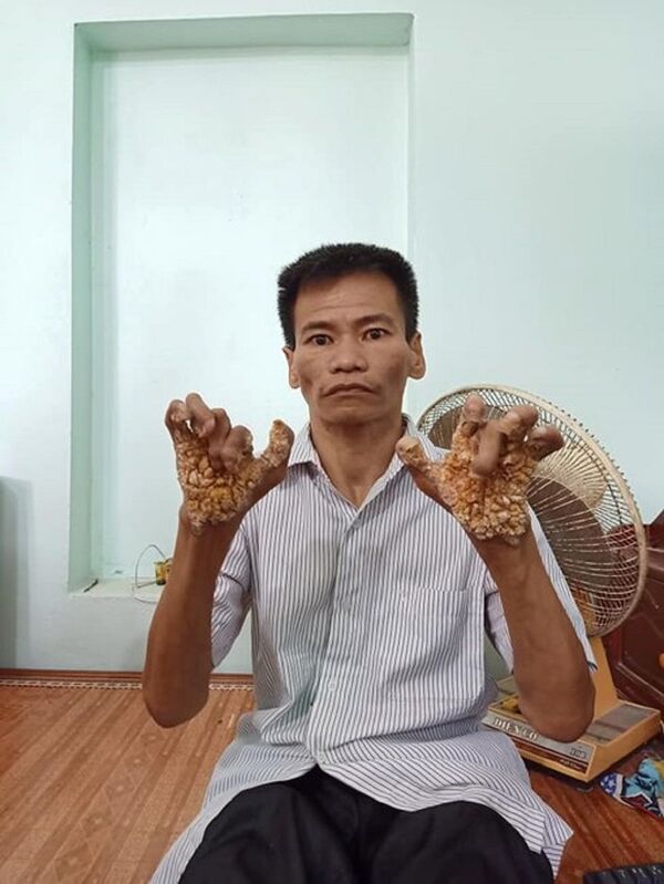 Việt Nam lần đầu tiên phát hiện “người cây”, căn bệnh ngoài da khủng khiếp Việt Nam lần đầu tiên phát hiện “người cây”, căn bệnh ngoài da khủng khiếp - Sputnik Việt Nam