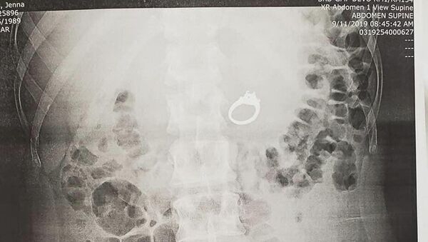 Chụp X-quang của Jenna Evans  - Sputnik Việt Nam