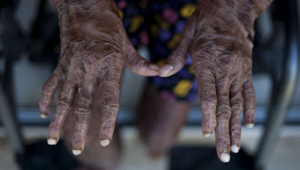 Bàn tay của một cô gái bị bệnh ichthyosis Shalini Yadav đến từ Ấn Độ - Sputnik Việt Nam