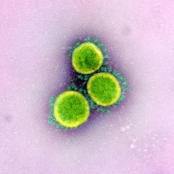 Ảnh vi mô phân tử coronavirus trong tế bào của người bị lây nhiễm  - Sputnik Việt Nam